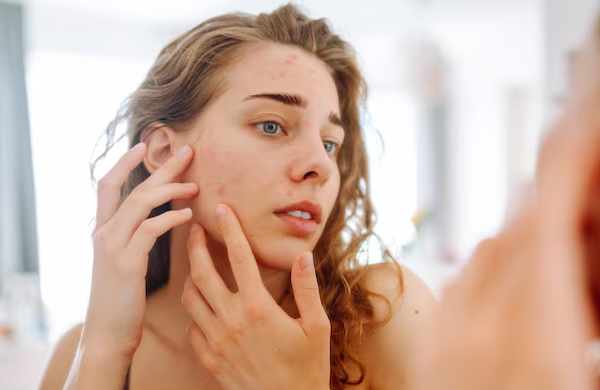Acne and Skin Treatment