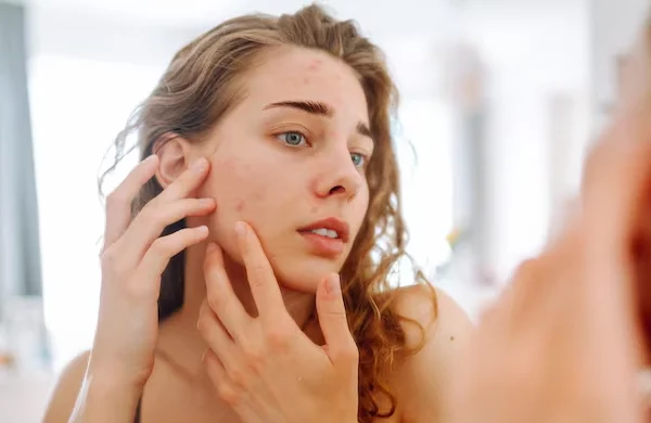 Acne and Skin Treatment