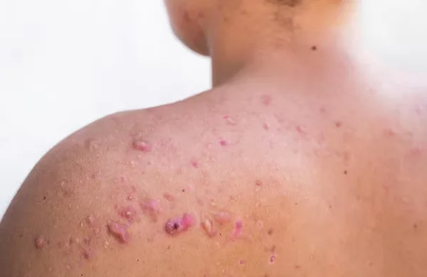 Skin Infections and Allergies